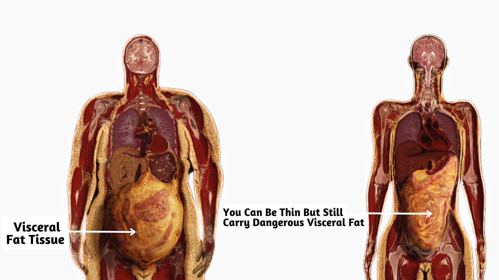 metabolic therapy for obesity treatment. you can be thin but still carry dangerous visceral fat