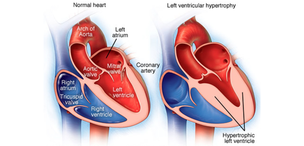 Before and after results of vascular health restoration for heart disease patients